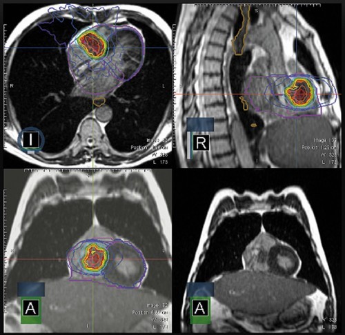 Abb. 3: Aufnahmen eines Herztumors (Foto: LMU Klinikum, Strahlentherapie)