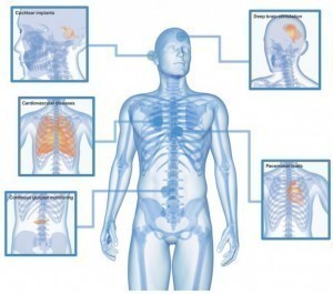 Präzisionsdrahtkomponenten: Einsatz im menschlichen Körper