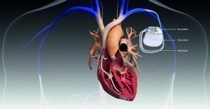 Abb. 2: Herzschrittmacher im Körper eingesetzt