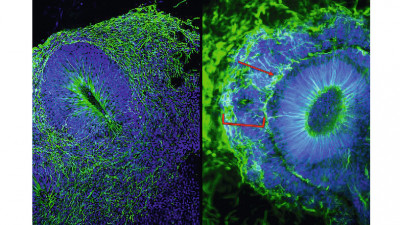 Rechts: Von mutierten Genen stammende Gehirn-Organoide zeigen falsch positionierte Zellen (rote Klammer; Zellkerne in Blau gefärbt) sowie ein Band von falsch positionierten Nervenzellen (rote Pfeilspitzen; in Grün gefärbt). Links: Gehirn-Organoiden von gesunden Spenderzellen (Abbildung: HITBR)