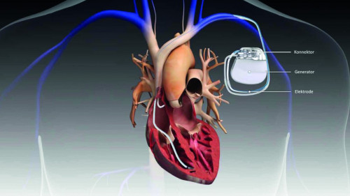 Abb. 1: Klassischer implantierter Herzschrittmacher 