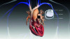Neues Design von Herzschrittmachern